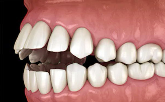 malocclusione teethan